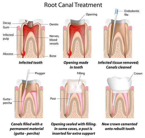 Root canal treatment