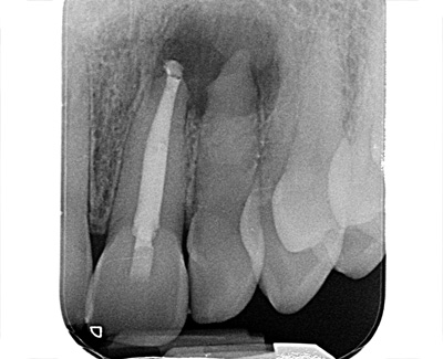 Custom fill of wide foramen