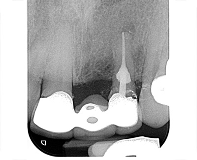 Internal resorption upper incisor