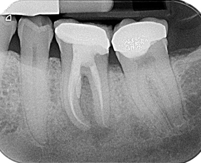 Repair of perforation on lower molar