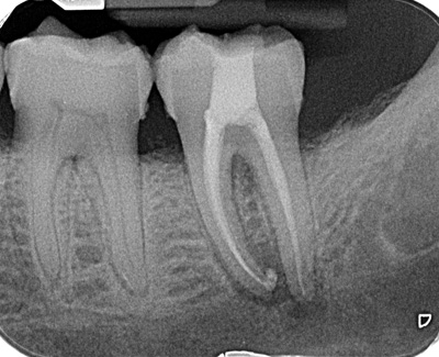Root treatemnt lower molar