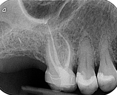 Root Treatment Upper Molar
