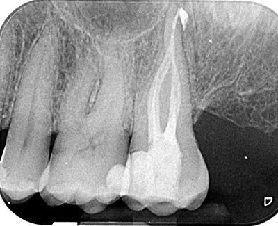 Root treatment upper molar