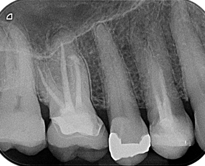 Surgical repair of upper molar