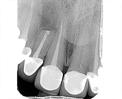 Surgical repair upper incisor