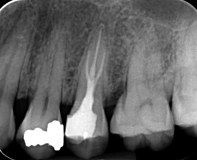 Upper Premolar